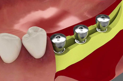 Osstem Dental Implants - Fort Dental Clinic