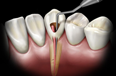 Endodontics (Root Canal Treatment) - Fort Dental Clinic