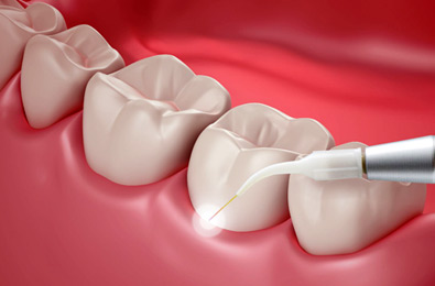 Laser Dentistry - Fort Dental Clinic