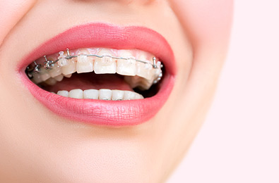 Orthodontics Treatment in Mumbai - Fort Dental Clinic
