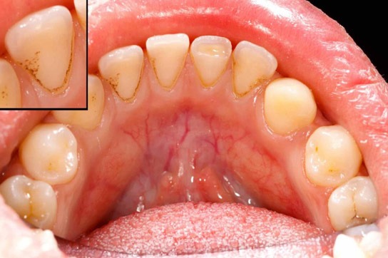 Dental Hygiene & Prevention