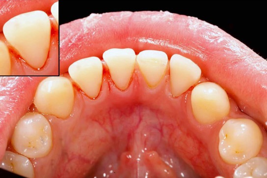 Dental Hygiene & Prevention