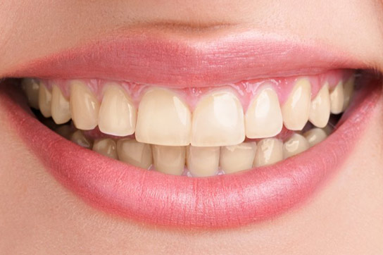 Teeth Whitening & Bleaching Treatment
