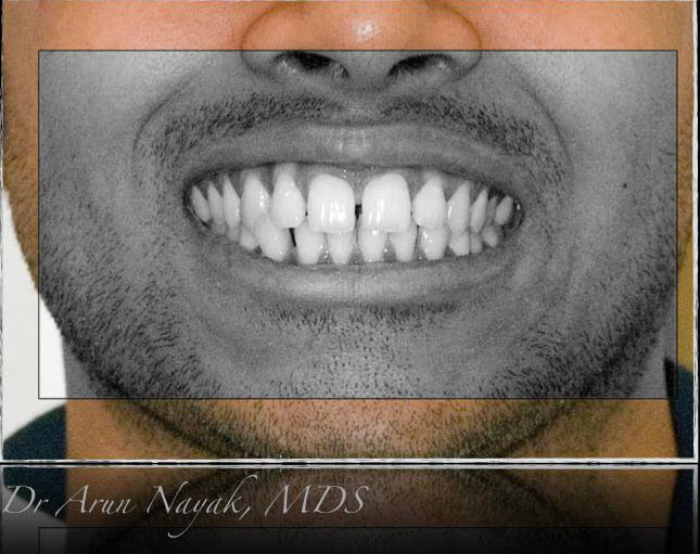 Gaps-between-teeth2