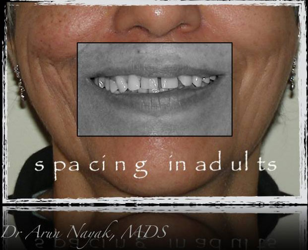 Gaps-between-teeth3