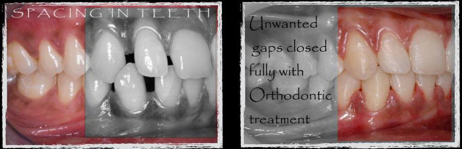 gaps between teeth braces close