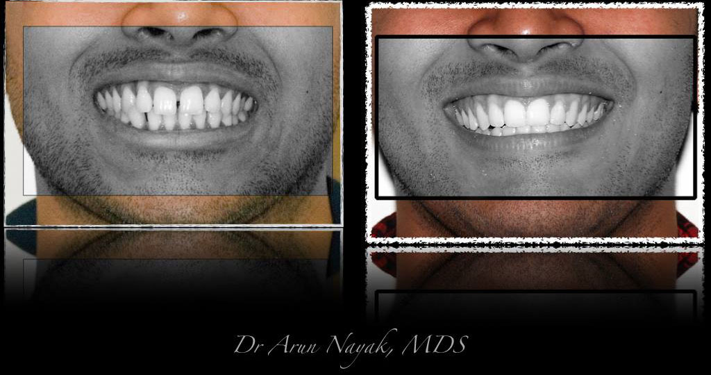 Gaps-between-teeth6