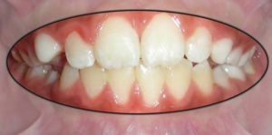 5-Thumb-sucking-and-incomplete-bites 5-Thumb-sucking-and-incomplete-bites