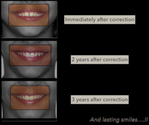6-Thumb-sucking-and-incomplete-bites