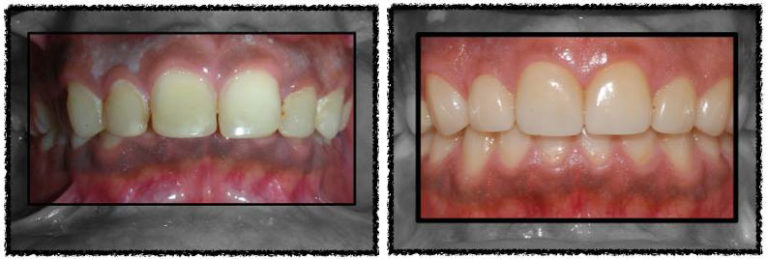 Surgery results Before and after smile photos showing dramatic change after lower jaw surgery