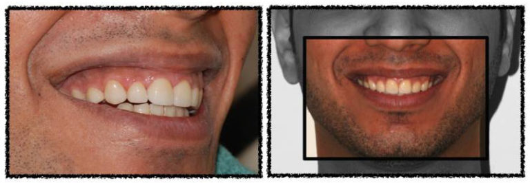 back a youthful smile and a sprightly set of teeth Final result photo of a youthful smile after small jaw correction in an adult