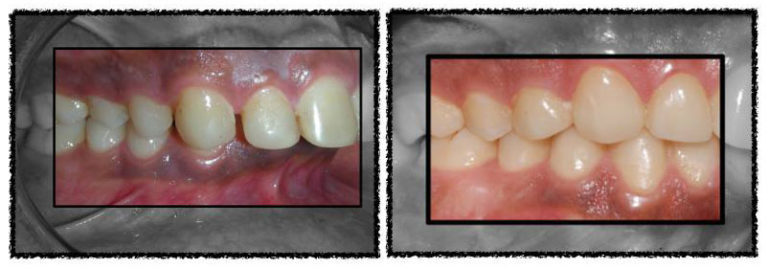 chewing ability improves significantly Close-up of back teeth showing improved bite and chewing after jaw surgery