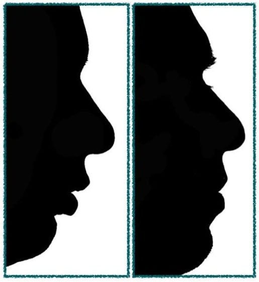 lower jaw can be resized with surgery Profile silhouette comparison showing surgical plan to correct a small lower jaw