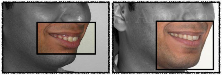 smile improve manifold Before and after profile view after surgical correction of a small jaw