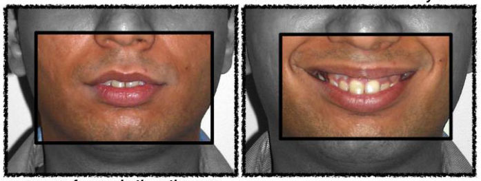 upper teeth appear more forwards Before photo showing how a small lower jaw makes the upper teeth appear more forward