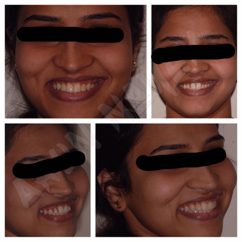 Smile Makeover!!