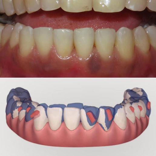 Invisalign can move anterior dental roots quite efficiently - Fort ...