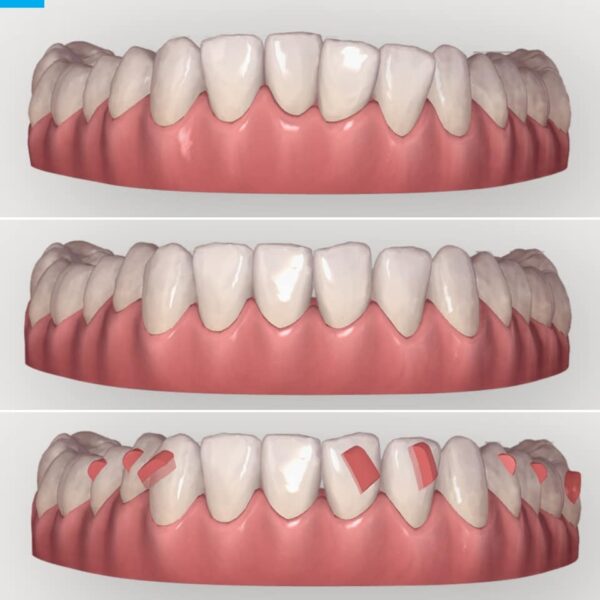 Choice of obliquely placed conventional attachments