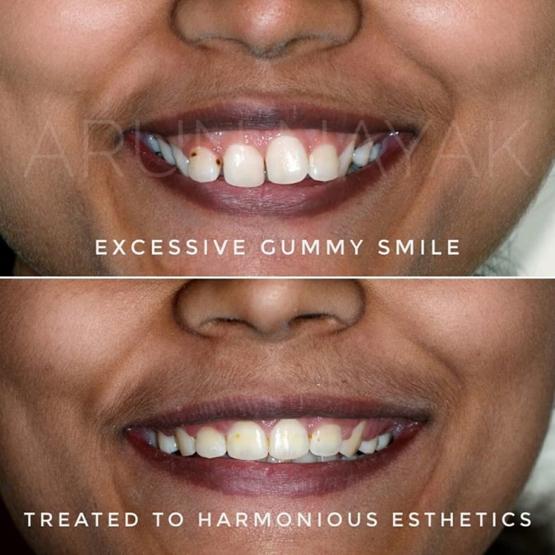 Orthodontic Retreatment