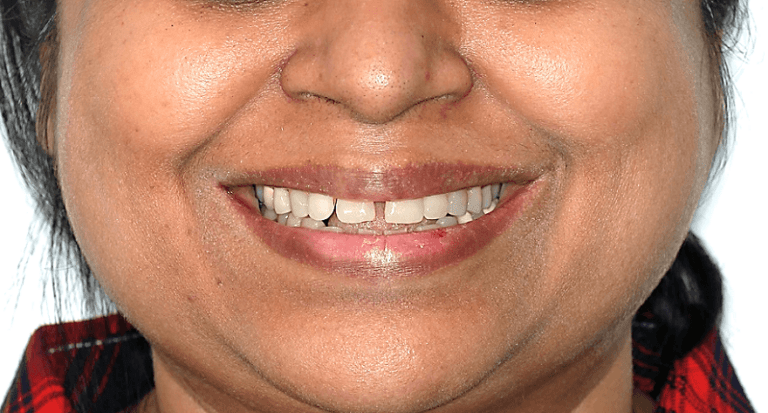 Case 1 Case 1: OPEN BITE