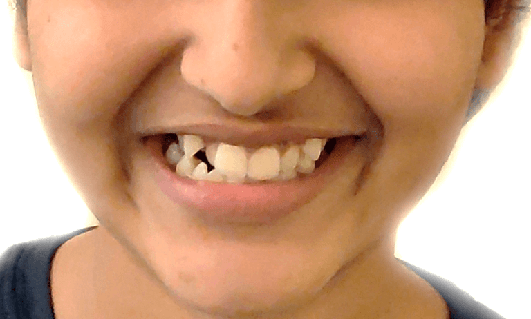 Case 4 Case 4: Crossbite/ClassIII