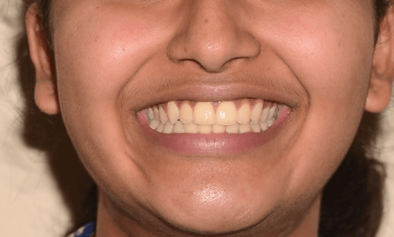 Case 44 Case 4: Crossbite/ClassIII