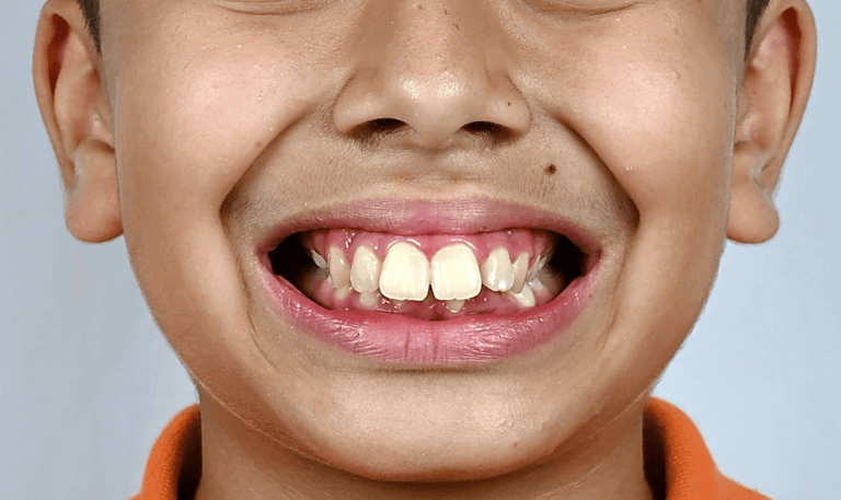 Case 5 Case 5: Class II Div 1/Deep Bite