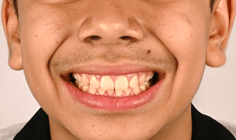 Case 55 Case 5: Class II Div 1/Deep Bite