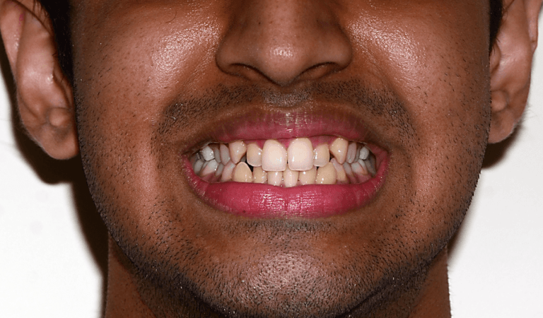 Case 6 Case 6: Highly placed canine