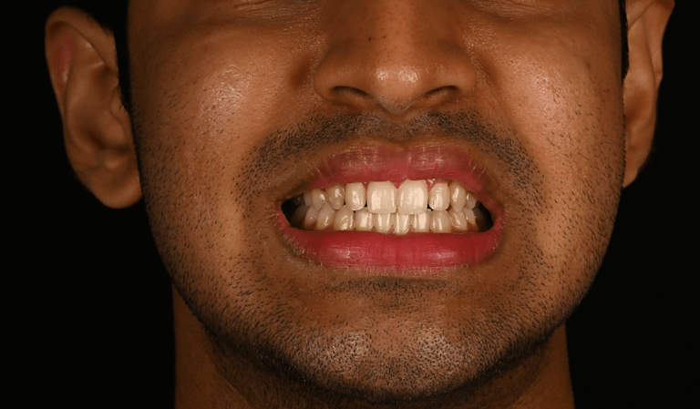 Case 66 Case 6: Highly placed canine