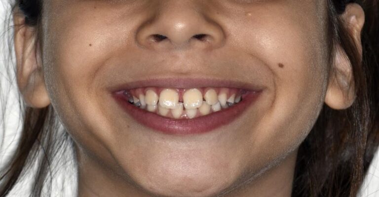 Case 8 Case 8: Mixed Dentition