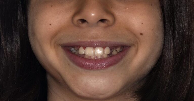 Case 88 Case 8: Mixed Dentition