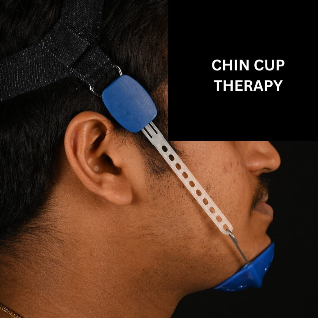 Chin Cup Therapy Chin Cup Therapy