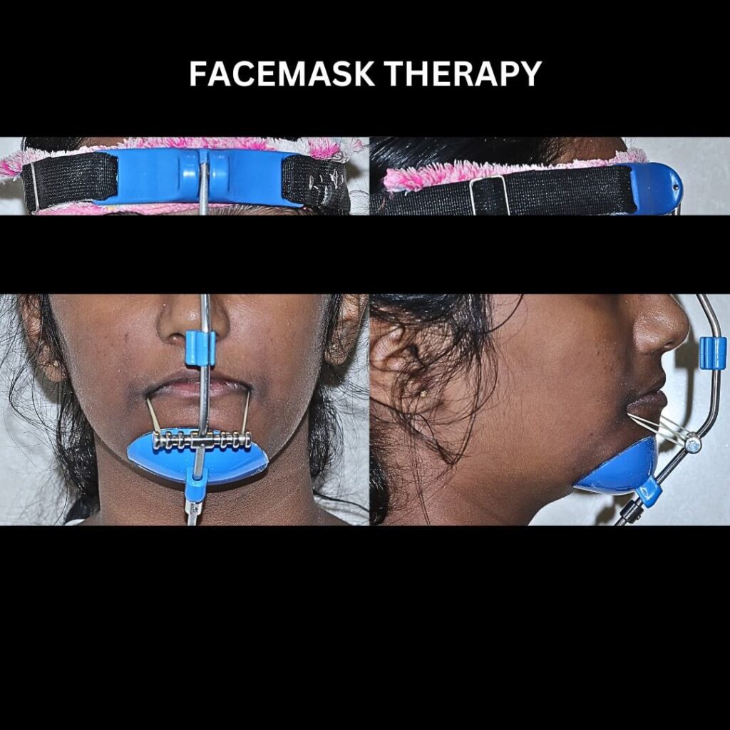 Facemask Therapy Facemask Therapy