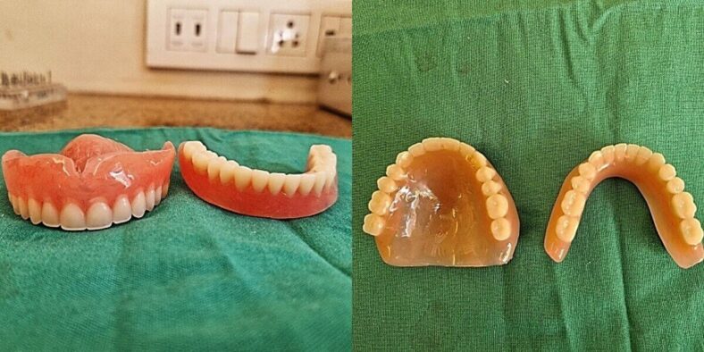 Dental Implants vs. Dentures Which One Is Right