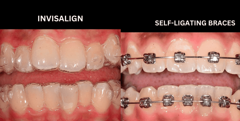 braces-vs-invisalign