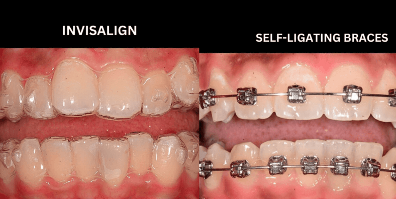 braces-vs-invisalign