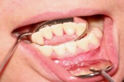 Gum-Disease-Periodontal-Treatment-