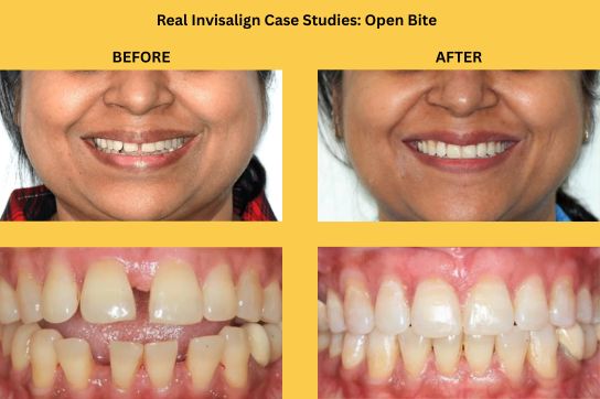 Invisalign Case Studies - Open Bite