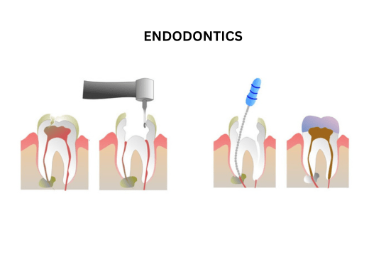 Root canal treatment