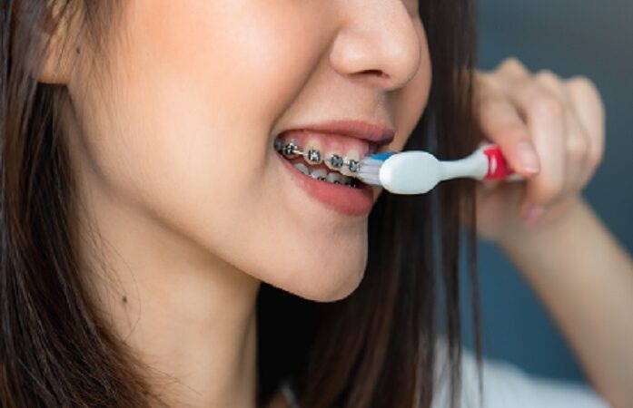Braces and Oral Hygiene