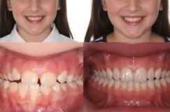 Palatal expander before and after