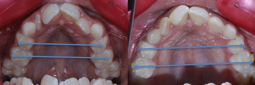 Before and After Expansion