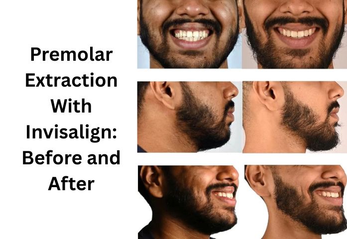 Before and After of Premolar Extraction with Invisalign