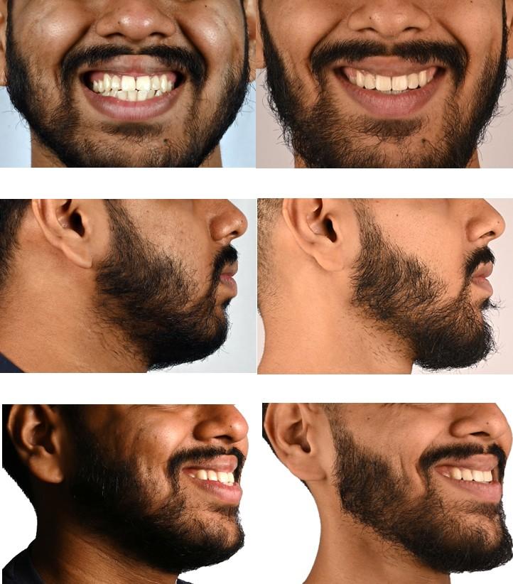 Before and After of Premolar Extraction with Invisalign patient photos