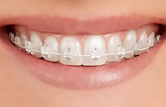Orthodontic Relapse After Braces