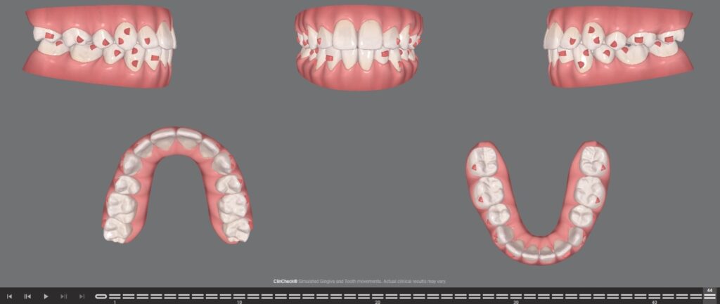 Planned Setup of Premolar Extraction