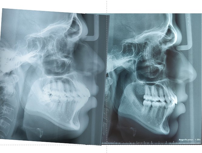 Pre and Post Xray's of patient during premolar extraction with Invisalign