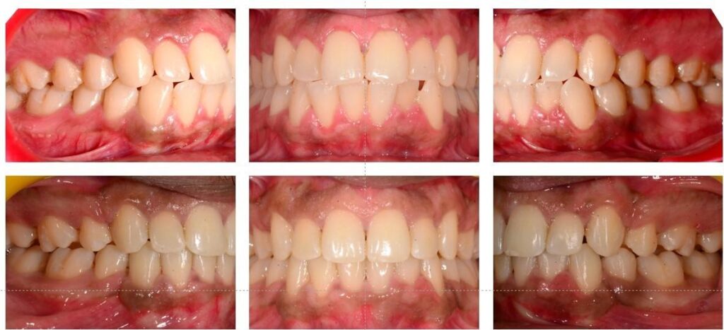 Treatment Results-Before & After Patient Photo
