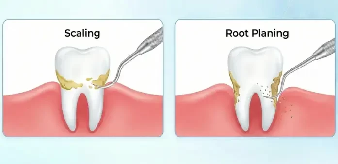 Scaling and Root Planing